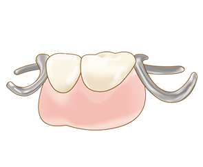 部分入れ歯
