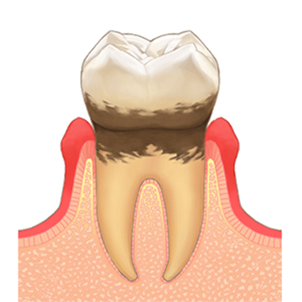 歯周炎の写真