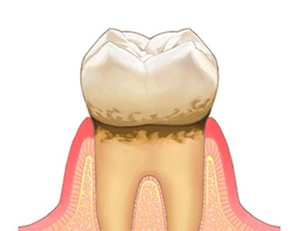 歯肉炎の写真